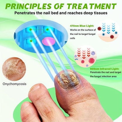 Nail Fungus Laser Treatment Device – FDA Cleared Anti-Fungal Laser for Toenail & Fingernail Fungal Infections, 7-Minute Home Treatment