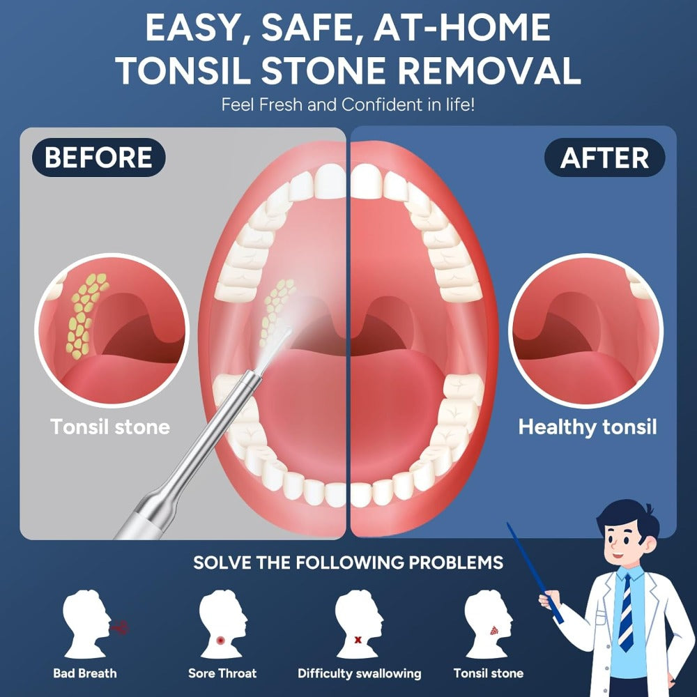 Visual Tonsil Stone Remover with 1080P HD Camera – 6 LED Lights, 5 Stainless Steel Heads, Bad Breath Prevention, iOS & Android Compatible, At-Home Tonsil Care Kit