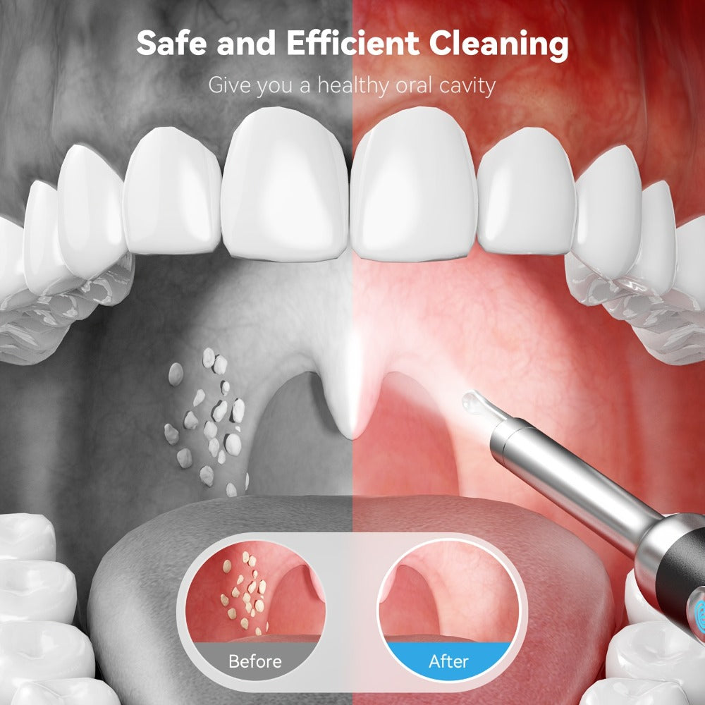 Intelligent Visual Tonsil Stone Removal Kit – 1080P HD Camera, 6 LED Lights, Wi-Fi & App Connection, Multi-Accessory Oral Inspection Tool for All Ages