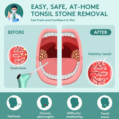 Tonsil Stone Remover Electric Vacuum Kit – Built-In LED Light, 3 Suction Modes & 5X Magnifying Mirror, Oral Irrigator for Safe Effective Tonsil Stone Removal at Home