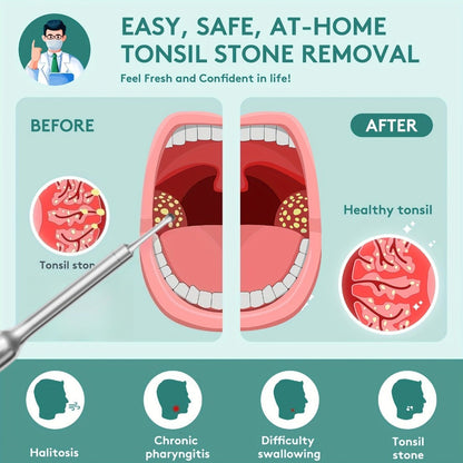 Visual Tonsil Stone Remover with 1080P HD Camera – 6 LED Lights, 5 Stainless Steel Heads, Bad Breath Prevention, iOS & Android Compatible, At-Home Tonsil Care Kit